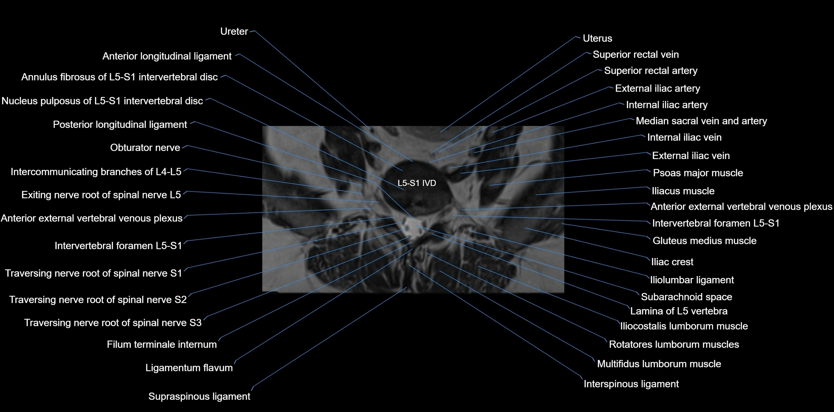 MRI sacrum, coccyx and sacroiliac joint axial cross sectional anatomy 3T  radiology  image-img-00001-00004.webp